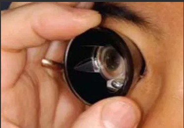 Picture of a gonioscope attached to an eyeball